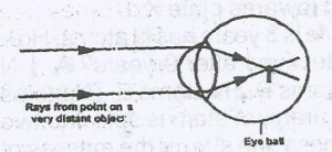 The eye defect illustrated in the diagram above can be corrected by a
